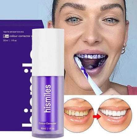 Hismile Teeth Whitening Kit – Fast, Safe, Pain-Free Whitening | Enamel-Friendly & Dentist-Approved