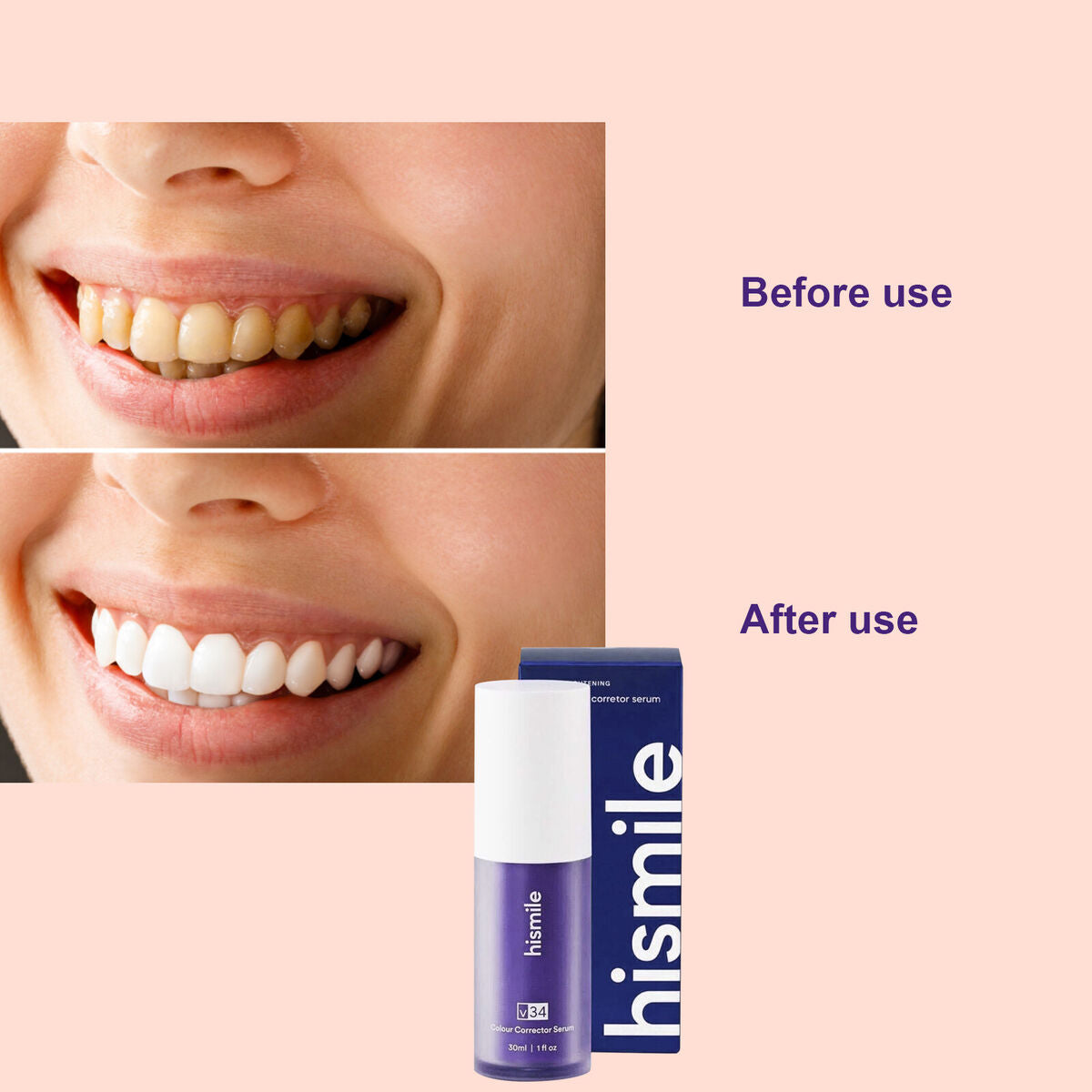 Hismile Teeth Whitening Kit – Fast, Safe, Pain-Free Whitening | Enamel-Friendly & Dentist-Approved